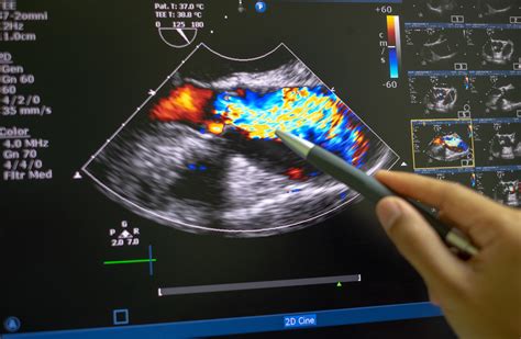 Echocardiography .